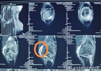 张源伤情：左膝关节内侧副韧带撕裂&内侧副韧带上止点水肿